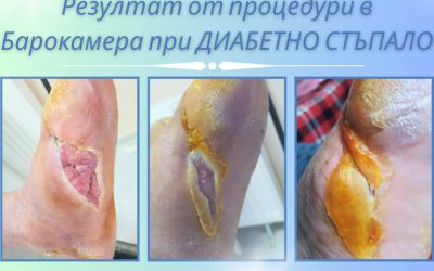 Резултат от процедури в Барокамера , при Диабетно стъпало